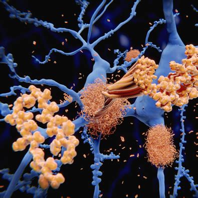 Estimates of amyloid onset may predict Alzheimer’s progression.